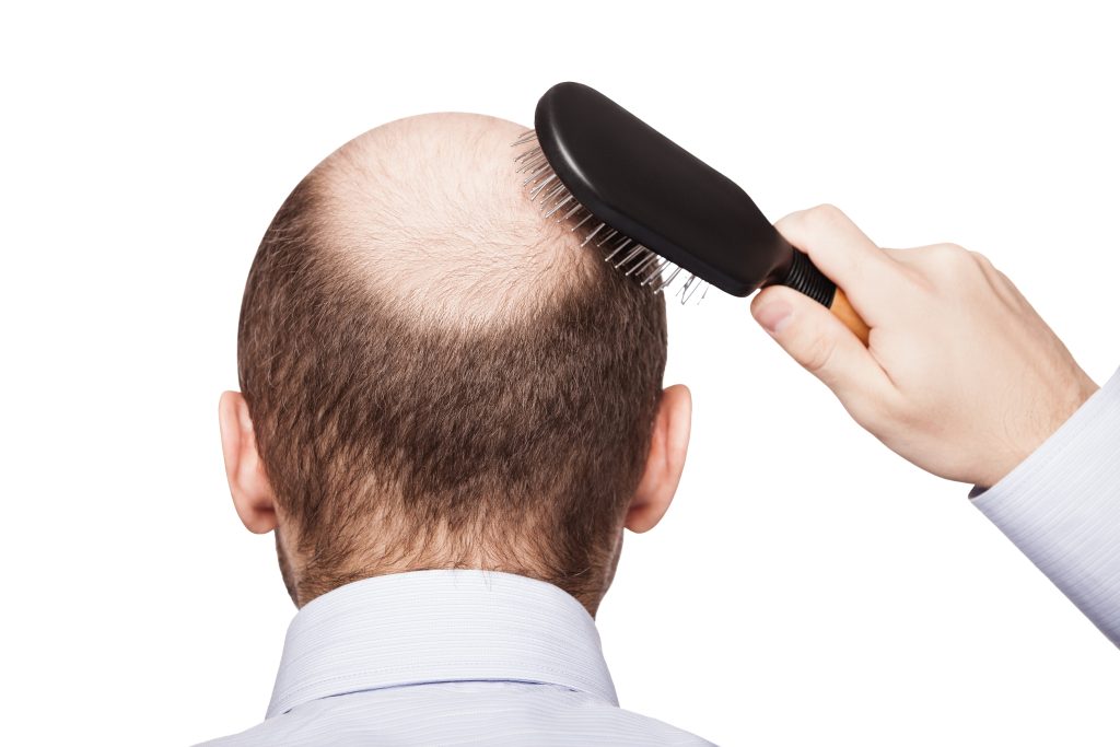Scalp Micropigmentation Garden City NY